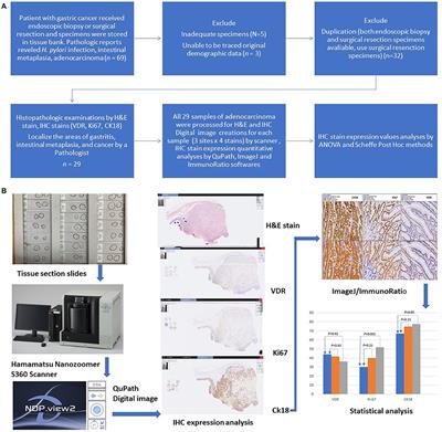 Comparing the Expressions of Vitamin D Receptor, Cell Proliferation, and Apoptosis in Gastric Mucosa With Gastritis, Intestinal Metaplasia, or Adenocarcinoma Change